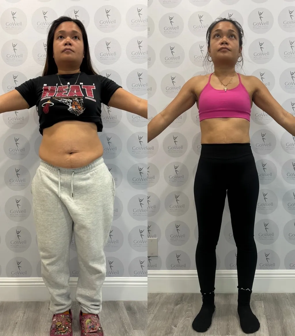 Before and after photos of a GoWell client's weight loss and body sculpting